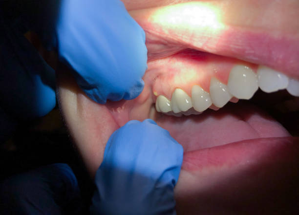Best Emergency Root Canal Treatment in Mount Zion, GA